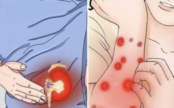 8 Possible Early Warning Signs of Chronic Kidney Disease – Dogrupara News