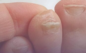 Causes and Treatments for Thick Toenails – Dogrupara News