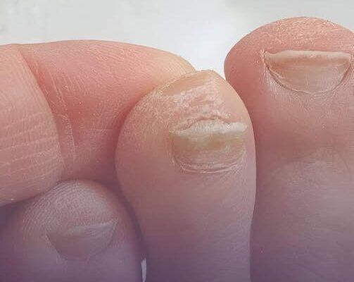 Causes and Treatments for Thick Toenails – Dogrupara News