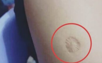 What the small round scar on your arm might indicate – Dogrupara News