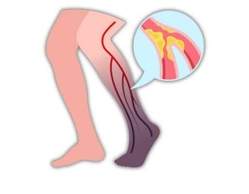 10 Warning Signs of a Blood Clot in the Leg You Should Know – Dogrupara News
