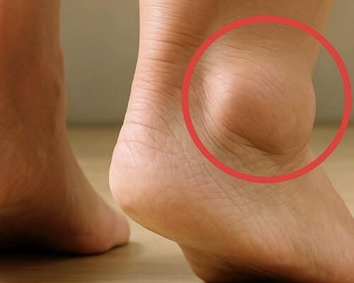 What Causes Swollen Feet in Seniors? – Dogrupara News
