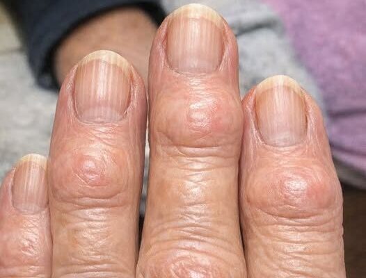 What Causes Hard Bumps on Finger Joints Near the Nails? – Dogrupara News