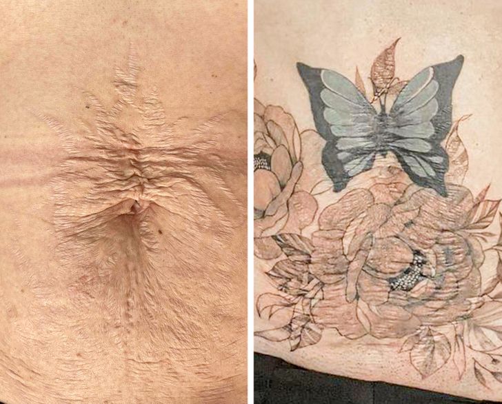 How Scar Cover-Up Tattoos Are Helping People Transform Pain Into Personal Art