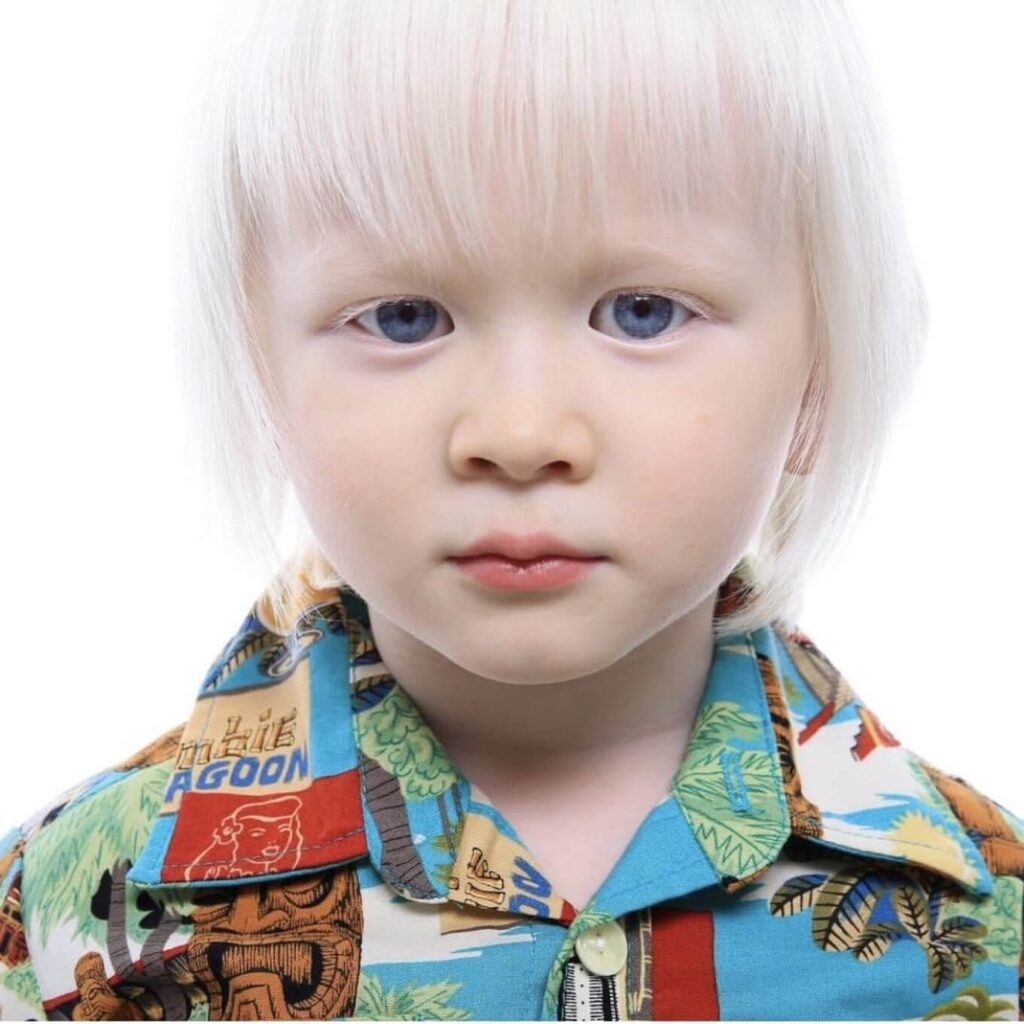 This boy was born 9 years ago with white hair, but here’s what he looks like now
