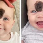 Her Parents Decided to Remove Her Birthmark to Protect Her and Here is How She Looks Years Later…