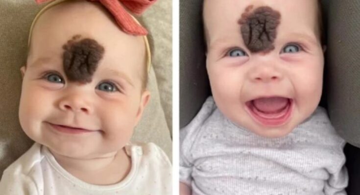 Her Parents Decided to Remove Her Birthmark to Protect Her and Here is How She Looks Years Later…